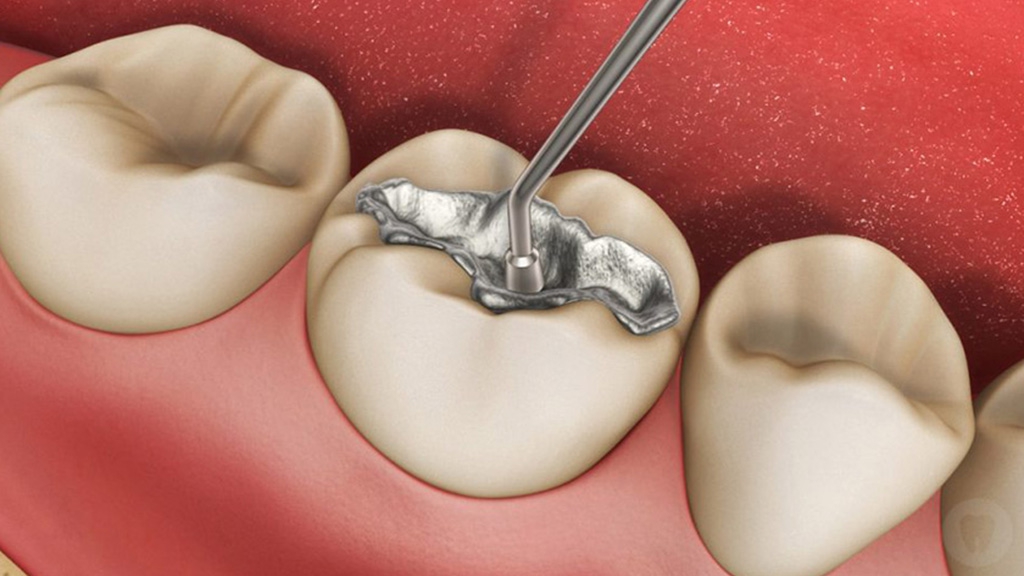 Thế nào là trám răng bằng amalgam? Liệu có an toàn không?