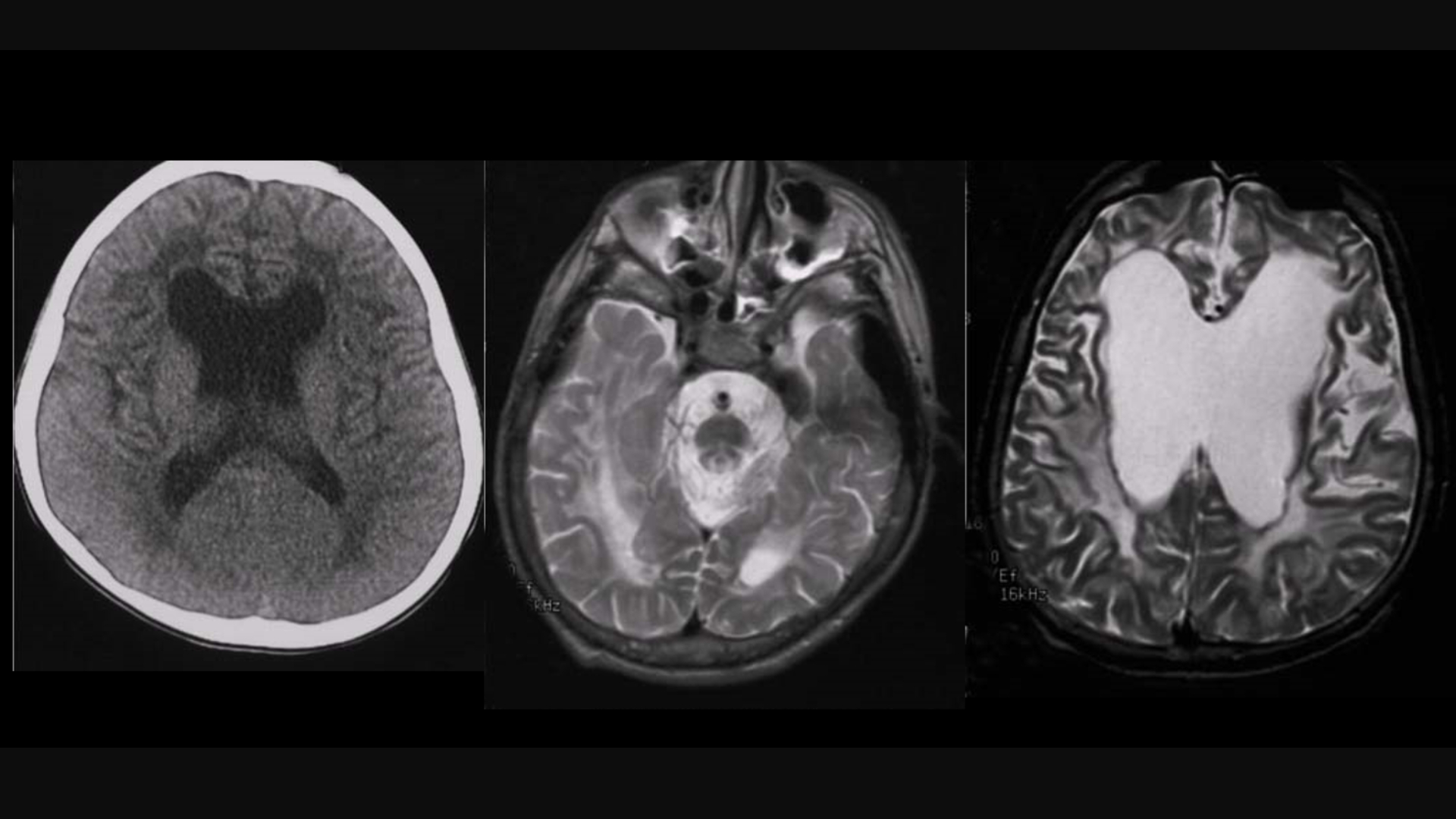 5. Điều Trị Thoái Hóa Myelin