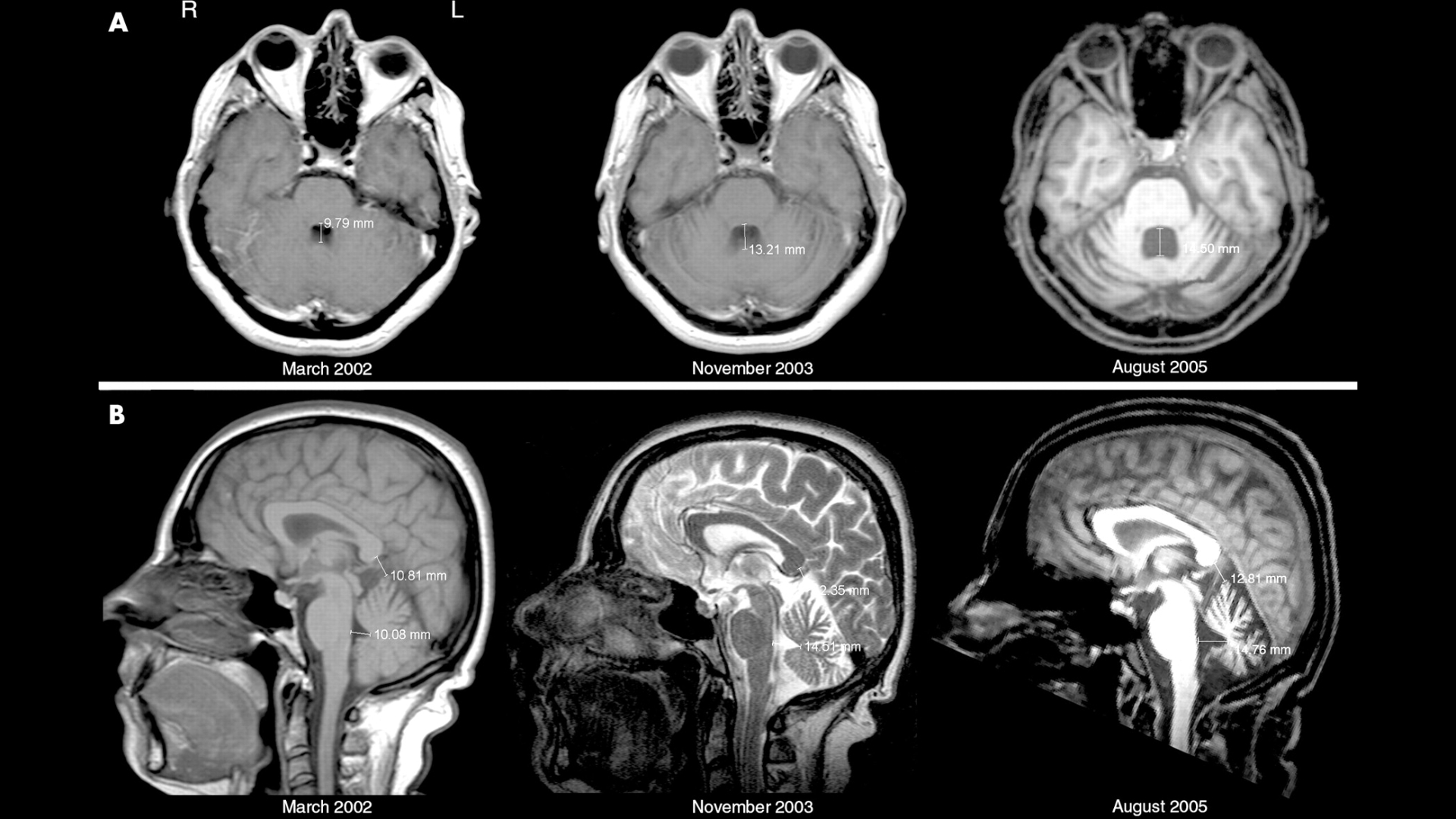 Thoái Hóa Não: Nguyên Nhân, Triệu Chứng và Cách Điều Trị Hiệu Quả