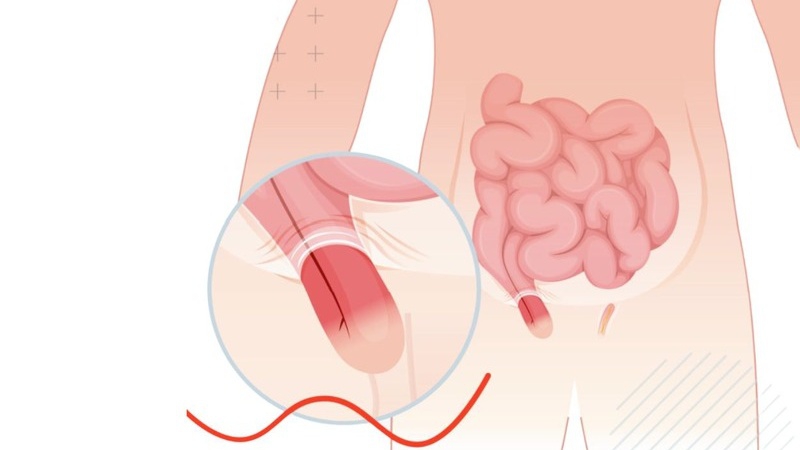 Thoát vị bẹn có nguy hiểm không? Nguyên nhân và cách điều trị 2