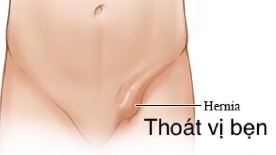 Thông tin về thoát vị bẹn ở bé gái bố mẹ cần lưu ý