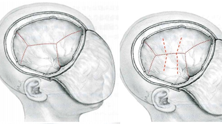 Thoát vị não là gì? Những vấn đề cần biết về Thoát vị não 4.jpg