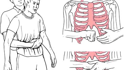 Nghiệm pháp Heimlich là gì? Cách thực hiện