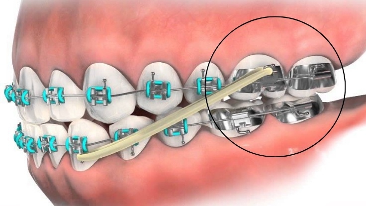 Band niềng răng là gì? Gắn band niềng răng có đau không? 3