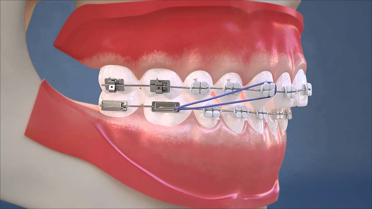 Thun liên hàm là gì? Ưu nhược điểm của thun liên hàm