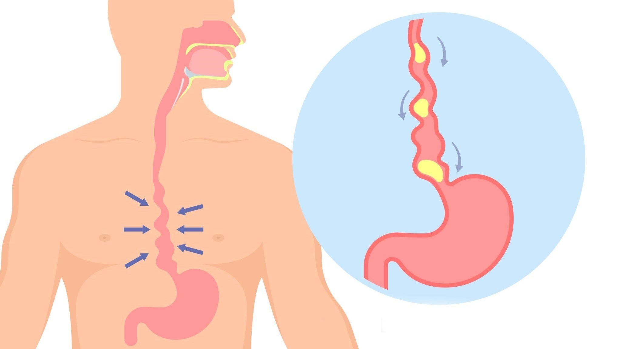 Thủng thực quản là gì? Nguyên nhân và phương pháp điều trị thủng thực quản