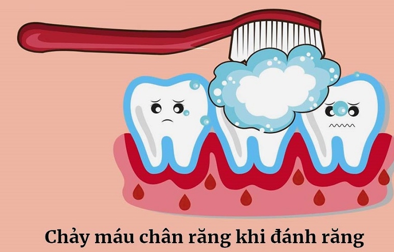 Thường xuyên bị chảy máu chân răng khi đánh răng có nguy hiểm không? 2