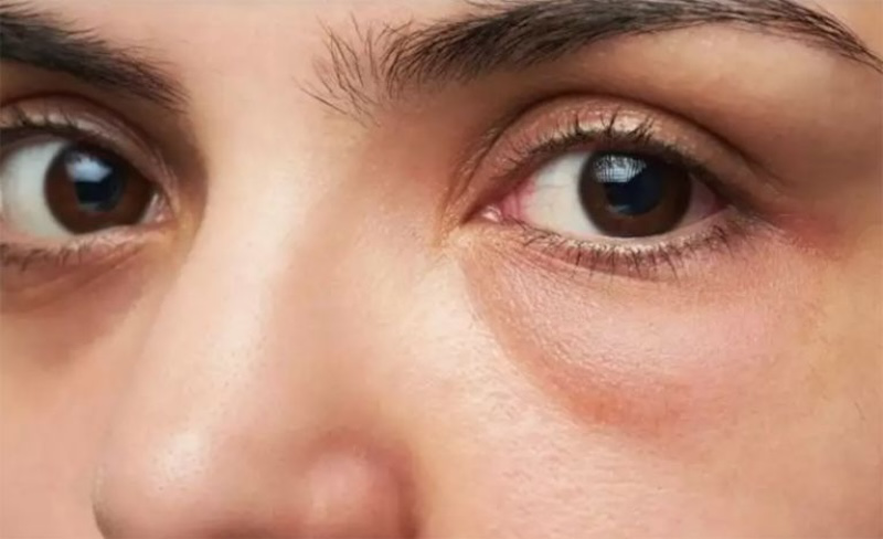 Tiêm filler hốc mắt có nguy hiểm không? Những thông tin cần biết 3