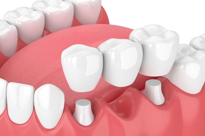 Tìm hiểu các phương pháp trồng răng phổ biến hiện nay 5