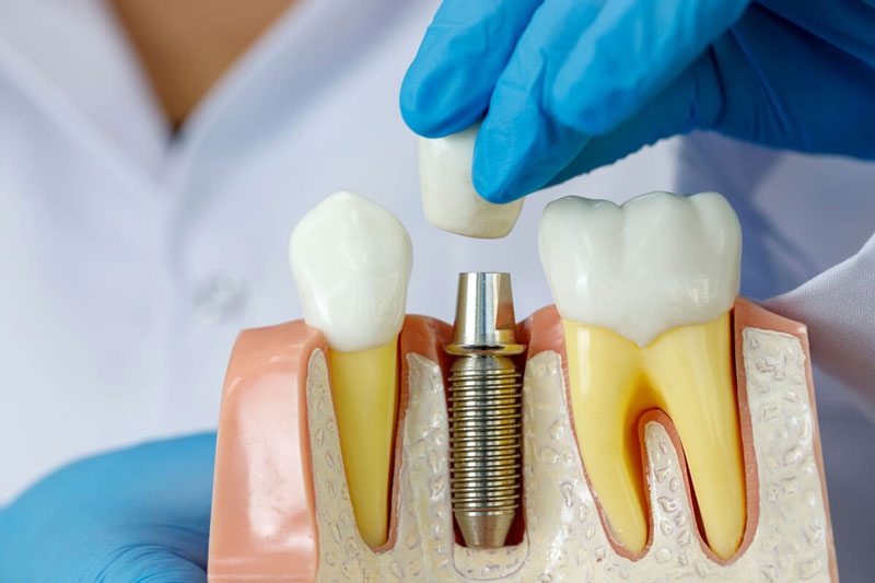 Tìm hiểu các phương pháp trồng răng phổ biến hiện nay 4