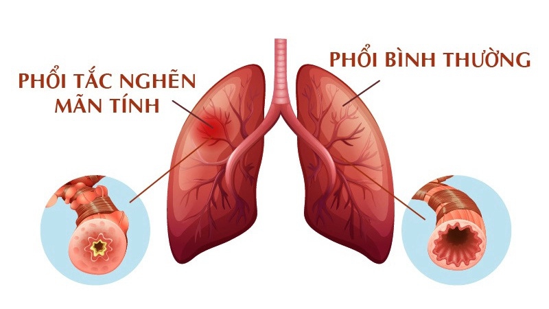 Tìm hiểu phương pháp nội soi phế quản đặt van một chiều chữa bệnh phổi tắc nghẽn mãn tính 1