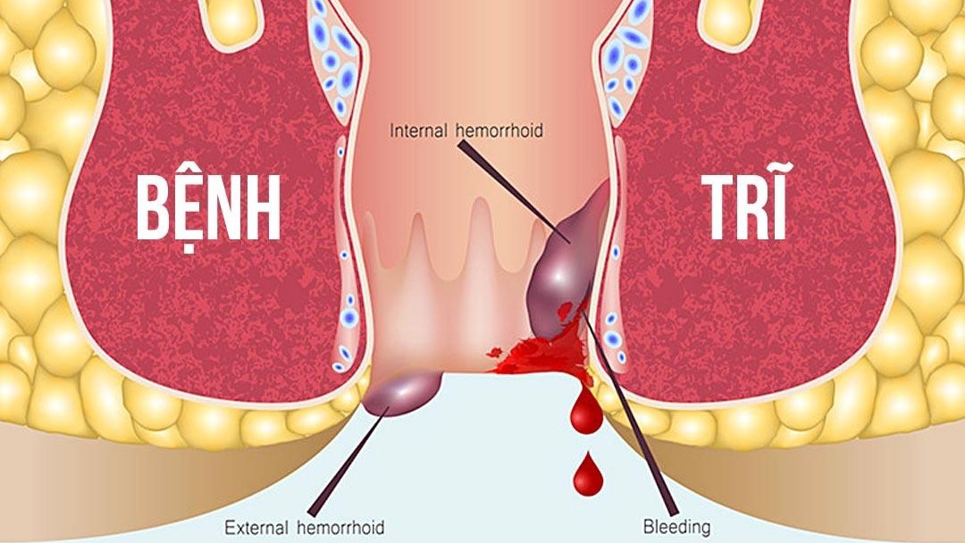 Bệnh trĩ nhiễm trùng: Nguyên nhân, triệu chứng, điều trị và phòng ngừa