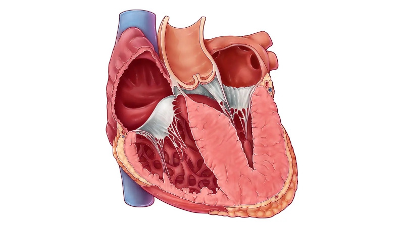 Tìm hiểu về phẫu thuật cắt bỏ vách ngăn cơ tim phì đại 1