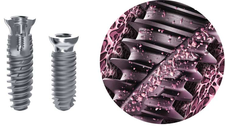 Tìm hiểu về trụ Implant Anthogyr trong nha khoa