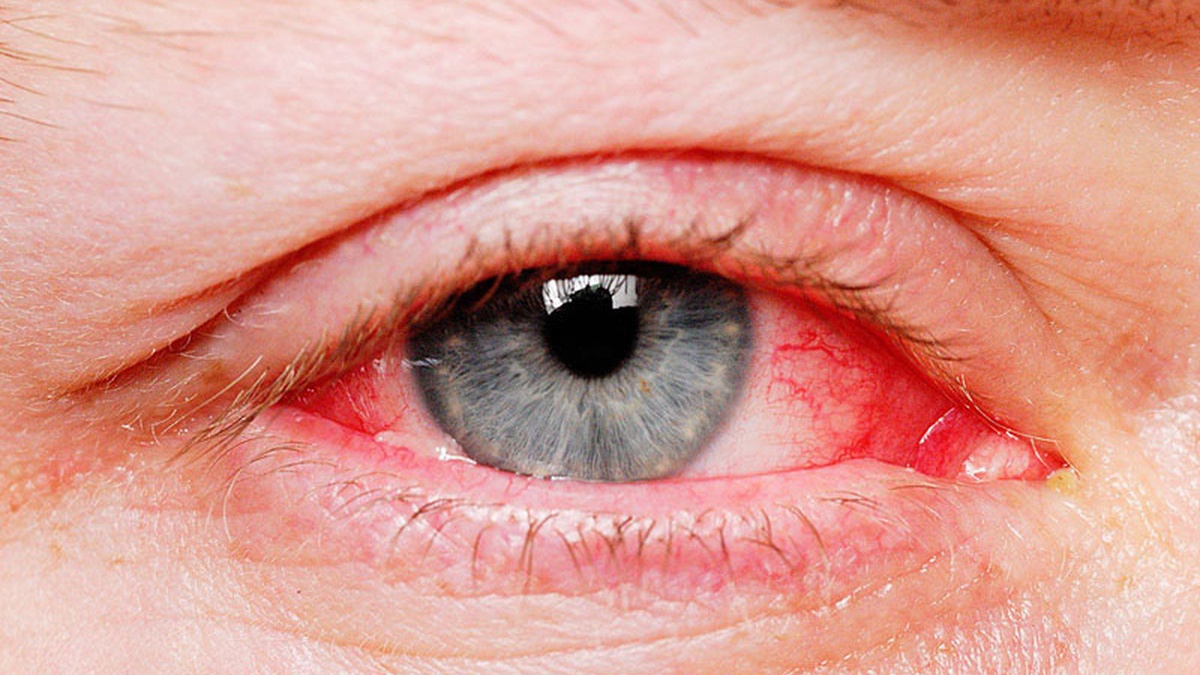 Có cách nào ngăn ngừa xuất huyết dưới mắt xảy ra?
