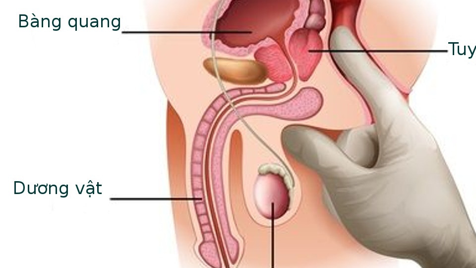 Tinh trùng trào ngược sau 30 phút nằm ngửa là tình trạng gì?