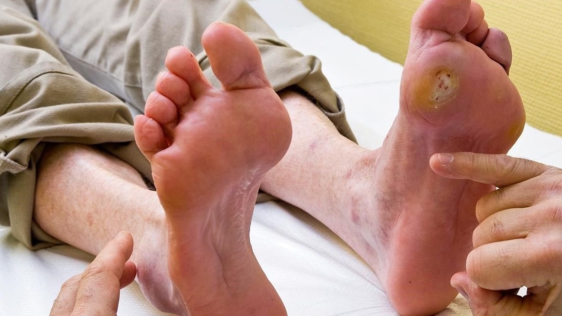 Các bước chăm sóc da cơ bản cho người bị mụn nước ở kẽ chân?
