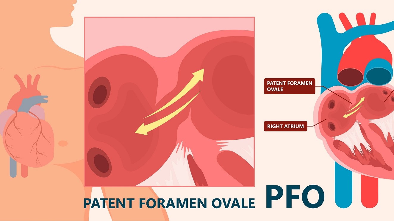 Tình trạng tồn tại lỗ bầu dục trong tim có nguy hiểm không?
