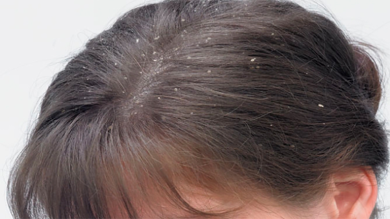 Dầu gội trị nấm da đầu Antisol có thành phần chính là gì?
