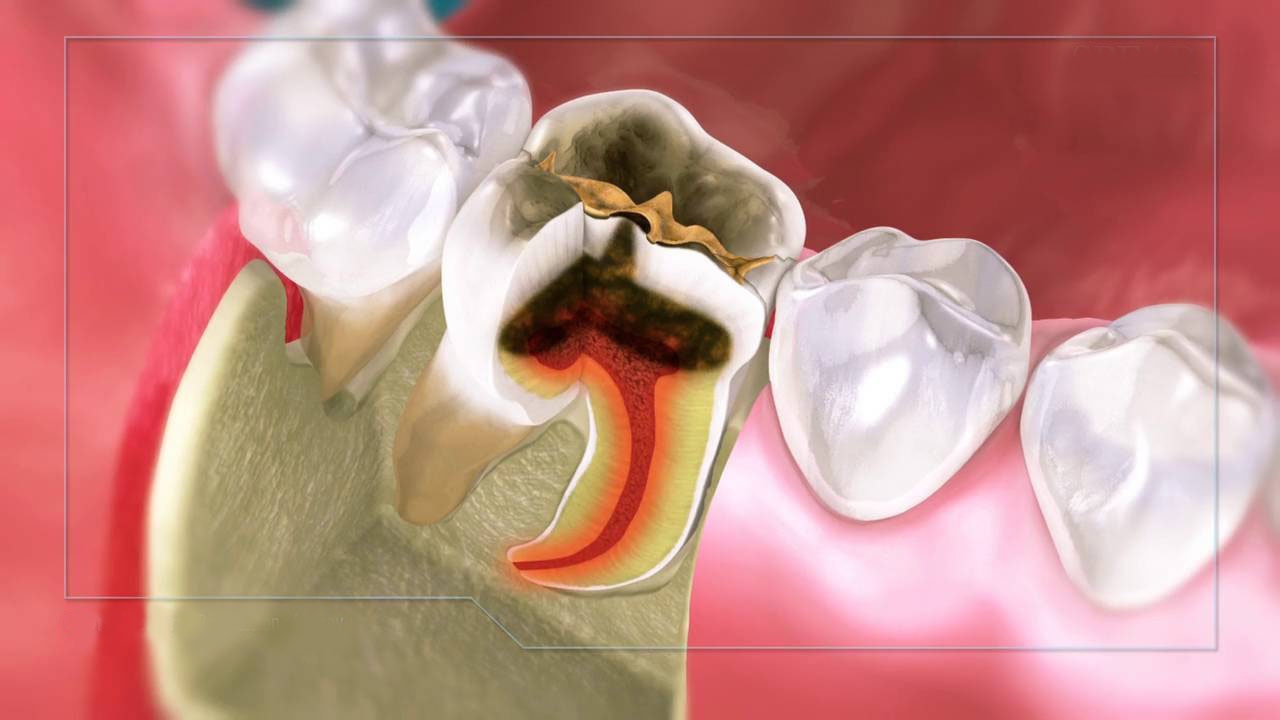 Những dấu hiệu cần lưu ý khi tính toán việc lấy tủy răng tại nhà hay đến nha khoa.