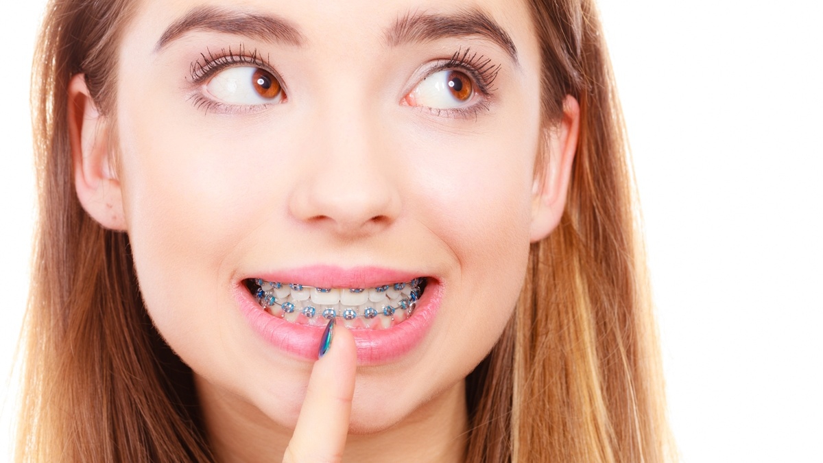 Nước súc miệng Kin Gingival có tác dụng gì cho người đeo niềng răng?
