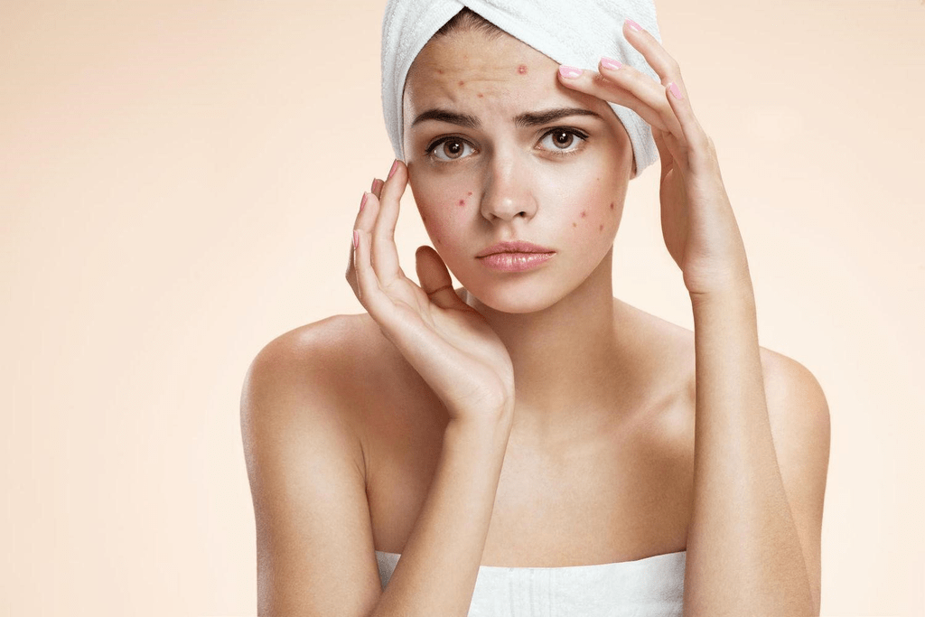 Top 5 toner trị mụn trả lại sự tự tin cho phái đẹp