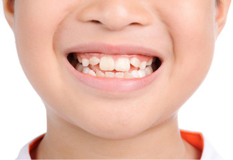 Trẻ bị gãy răng sữa có mọc lại không? Phải làm sao khi trẻ gãy răng?3