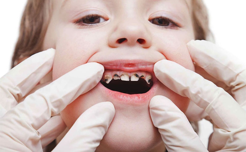 Điều trị sâu răng ăn vào tủy ở trẻ em có hiệu quả không?