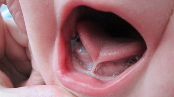 Trẻ sơ sinh dính thắng lưỡi là gì? Cách điều trị và chăm sóc