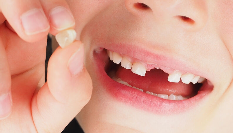 Răng vĩnh viễn thay răng sữa ở tuổi nào?
