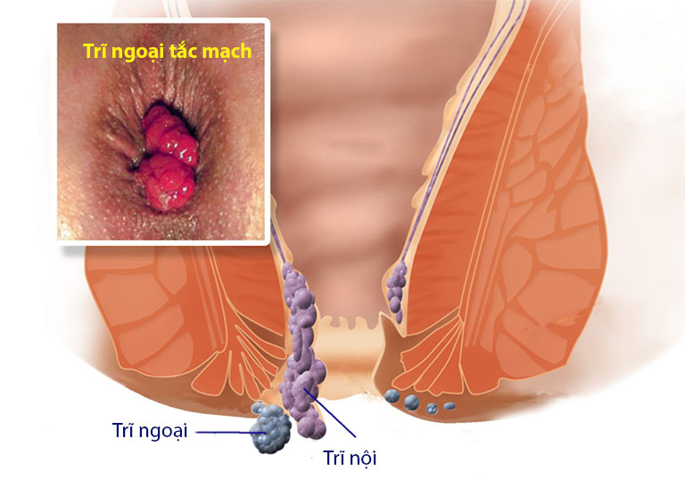 Trĩ là gì? Mách bạn cách phân biệt trĩ nội và trĩ ngoại dễ dàng 6