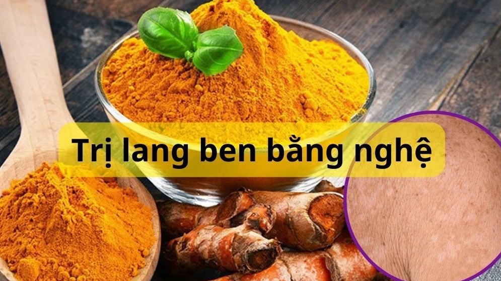 Một số cách trị lang ben bằng nghệ phổ biến nhất