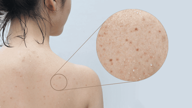 Trị mụn lưng bằng Lactacyd Baby Gentle Care đơn giản mang lại hiệu quả cao