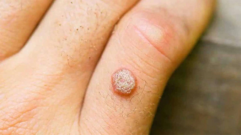 Trị mụn cóc bằng kem đánh răng có hiệu quả không? 1