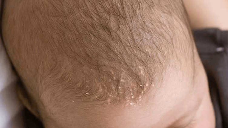 Có những phương pháp tự nhiên nào có thể hỗ trợ điều trị nấm da đầu ở trẻ em?