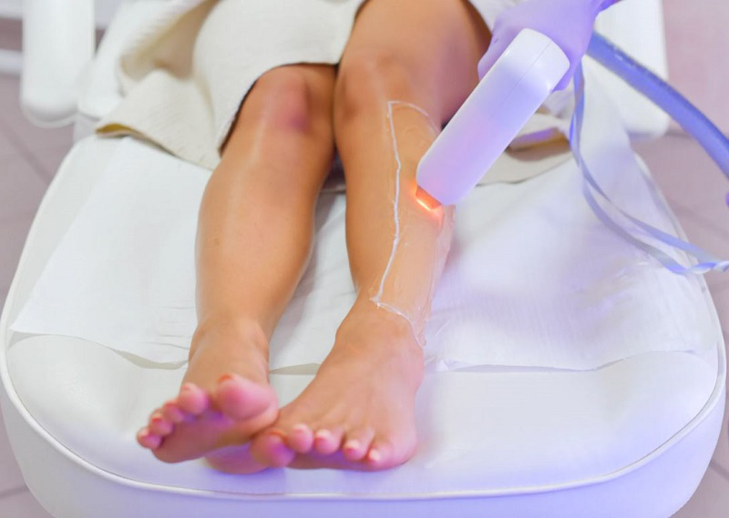 Triệt lông 1/2 chân là gì? Một số phương pháp triệt lông phổ biến hiện nay 3