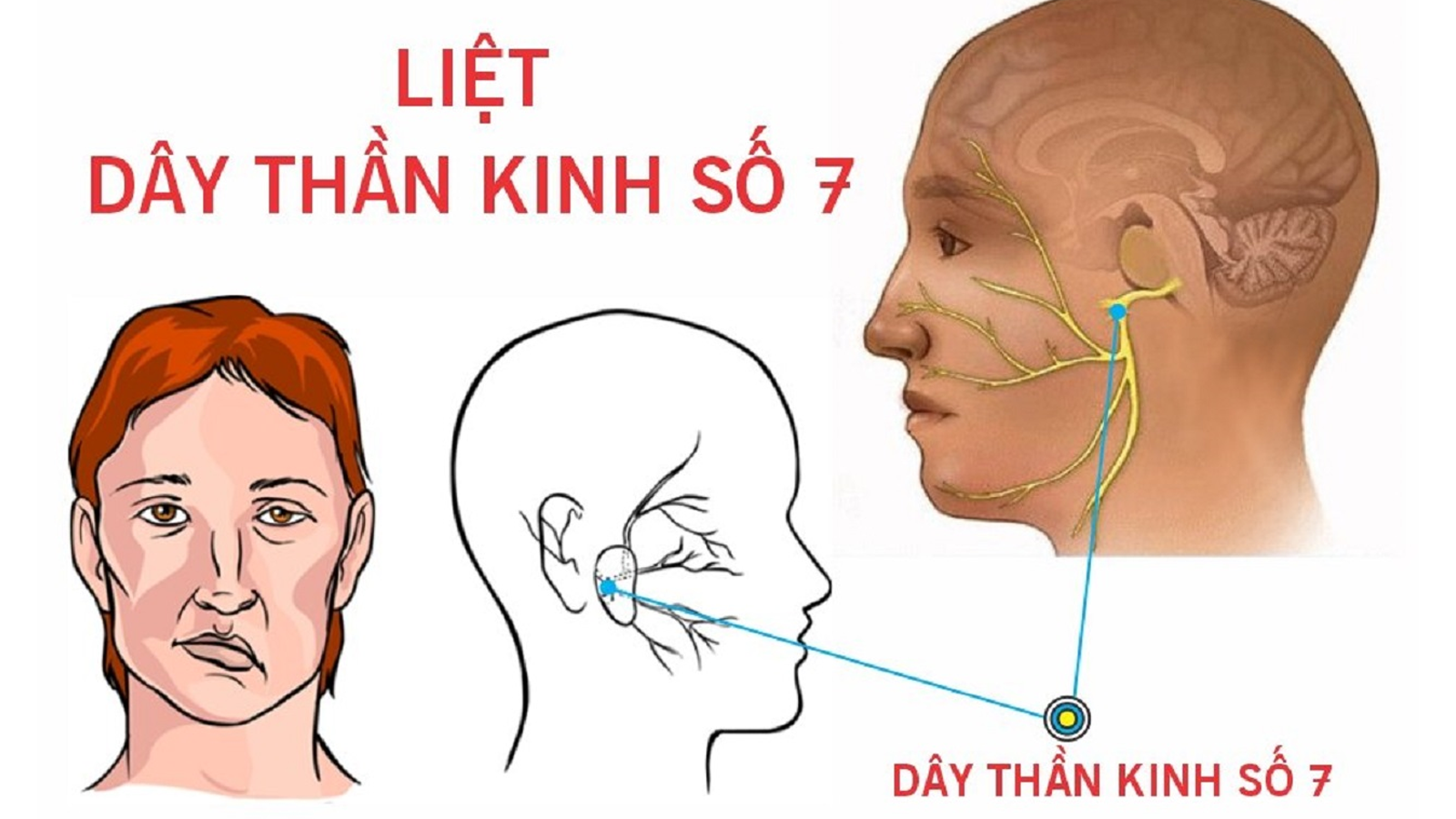 Triệu chứng liệt dây thần kinh số 7 là gì?