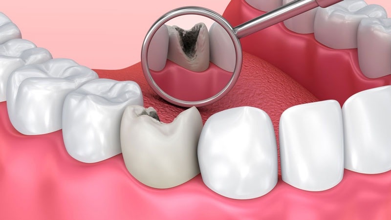 Những nguyên nhân gây ra triệu chứng sau khi lấy tủy răng?
