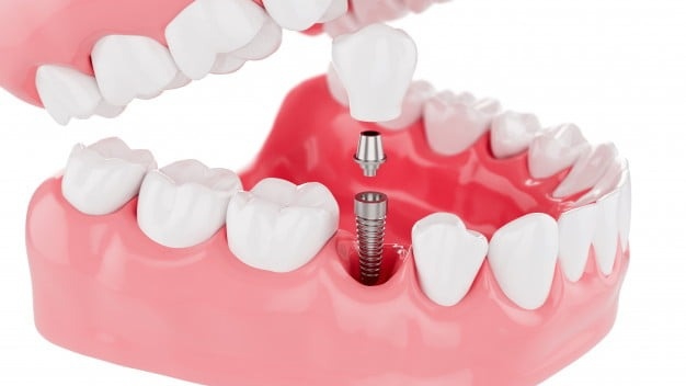 Trồng răng implant Hàn Quốc có tốt không?