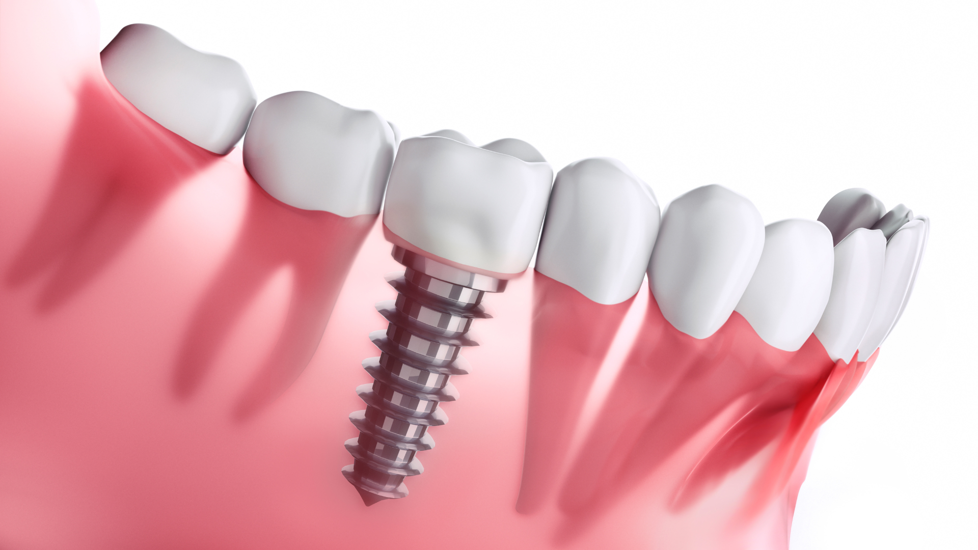Trồng răng sứ cố định là gì? Đối tượng nào nên trồng răng sứ cố định?