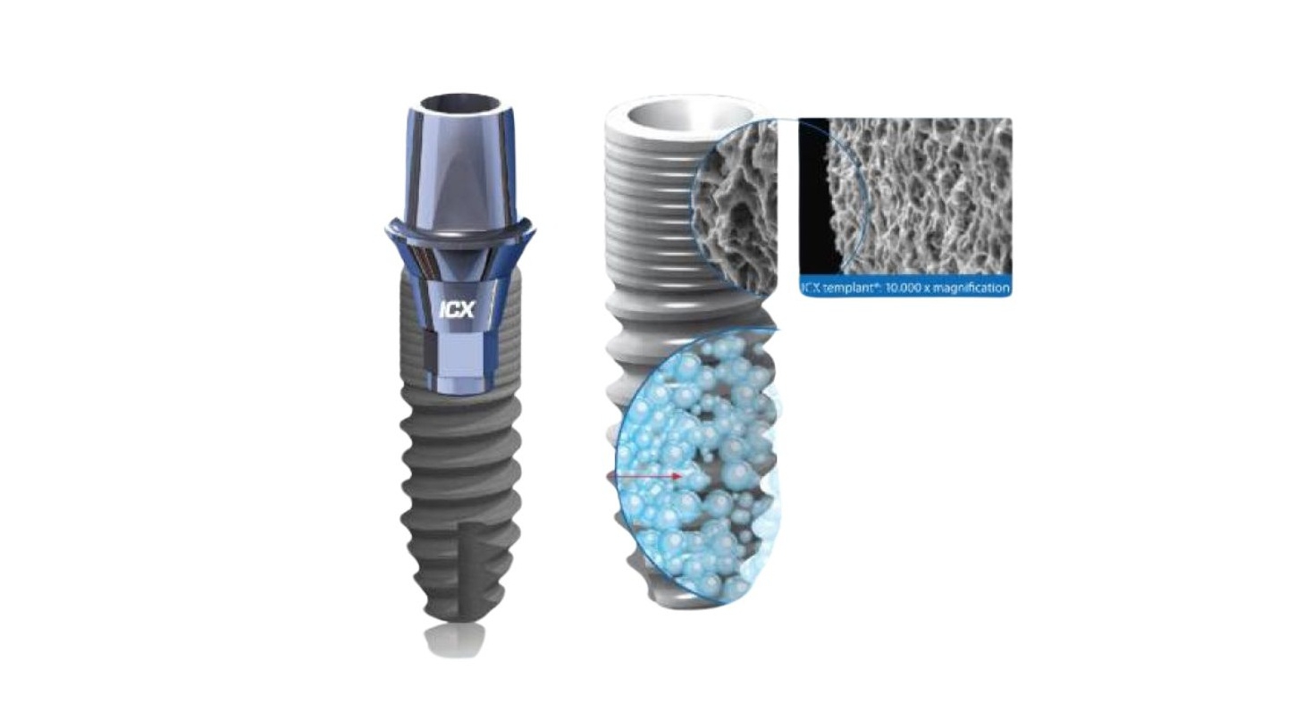 Trụ Implant ICX có tốt không? So sánh trụ Implant ICX với các loại khác