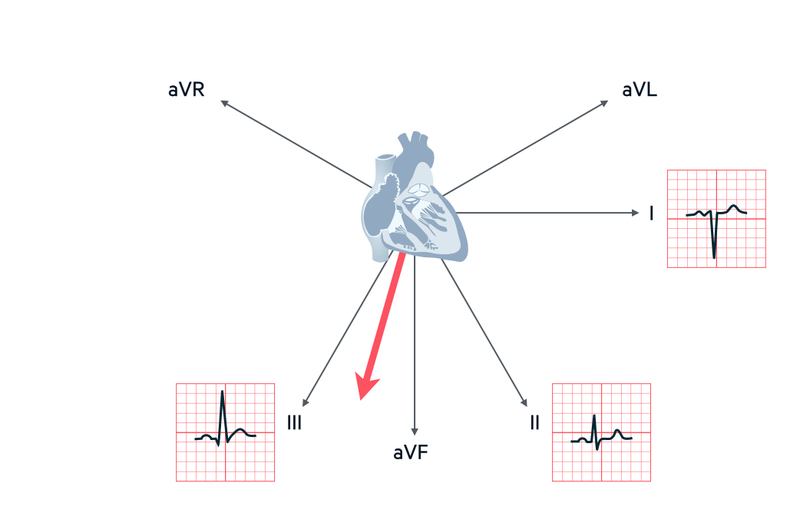 Trục điện tim lệch sang phải cảnh báo bệnh gì?3