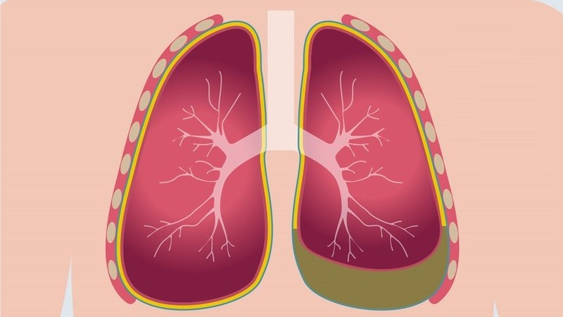 Trường hợp dịch màng phổi màu đỏ là gì?