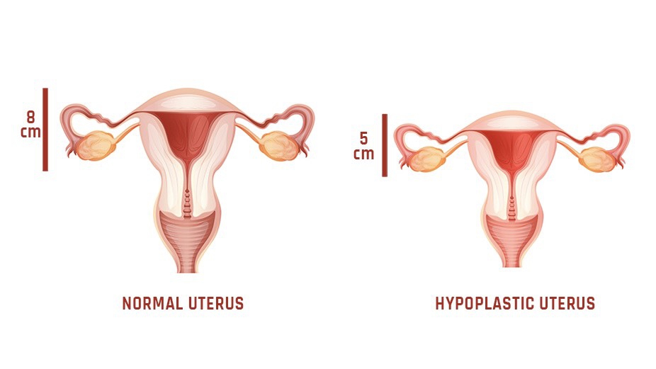 Tử cung nhỏ: Nguyên nhân và những dấu hiệu nhận biết