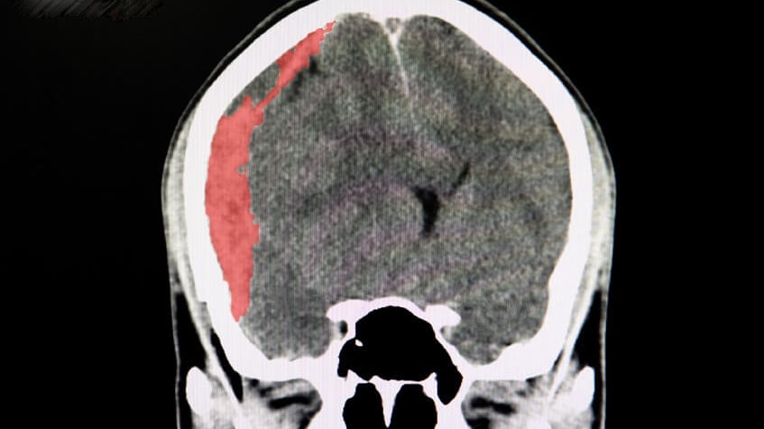 Tụ máu não sống được bao lâu? Có thể sống mà không cần phẫu thuật không?