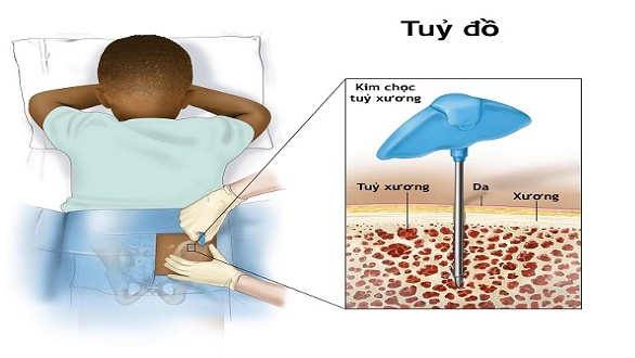 Mục đích thực hiện tủy đồ và sinh thiết tủy và quy trình thực hiện 1