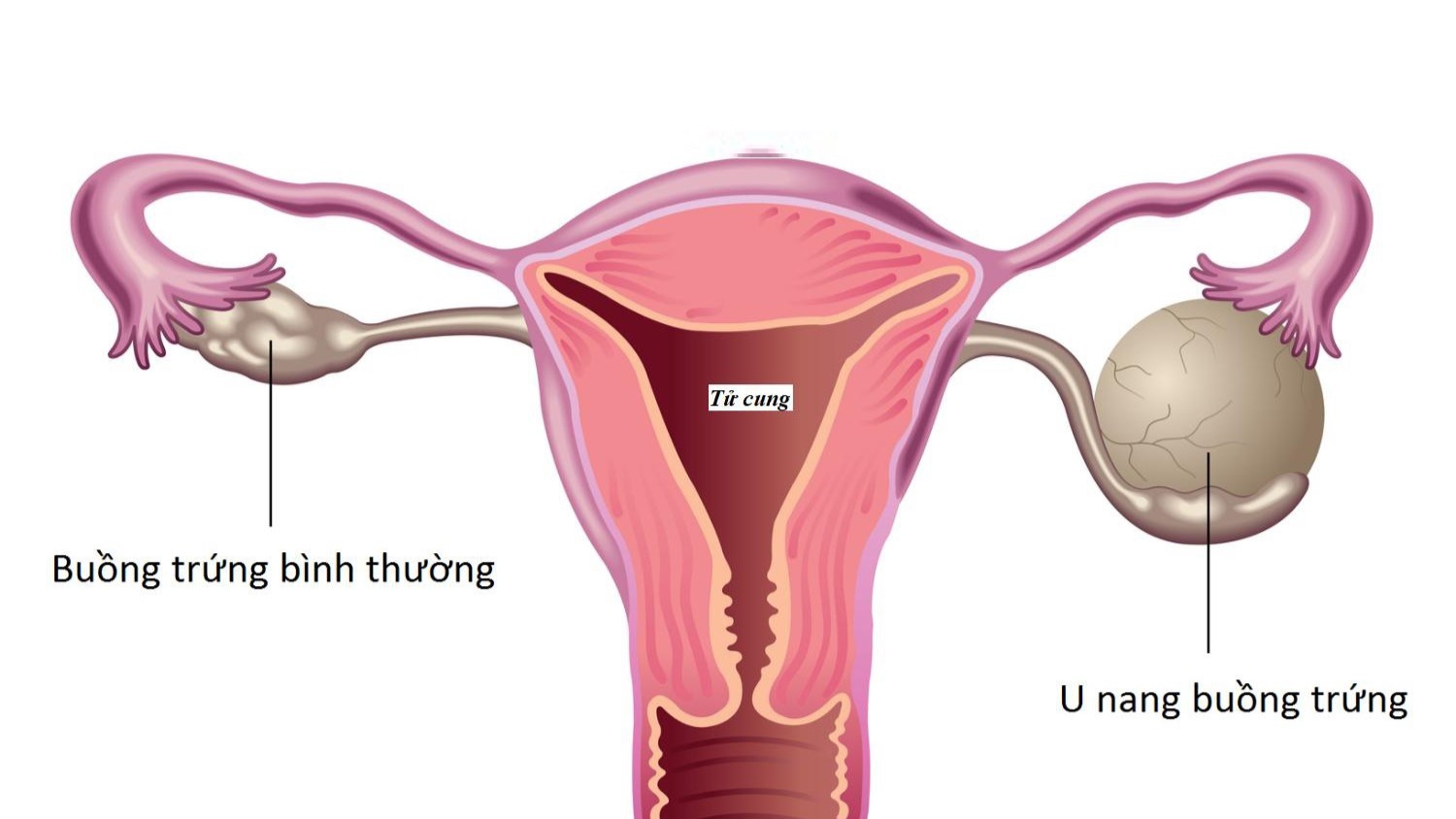 U nang nhầy buồng trứng có cần phẫu thuật không?