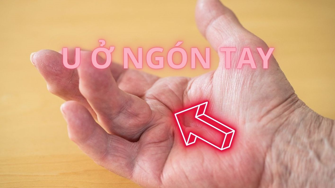 Xuất hiện u ở ngón tay báo hiệu bệnh gì?