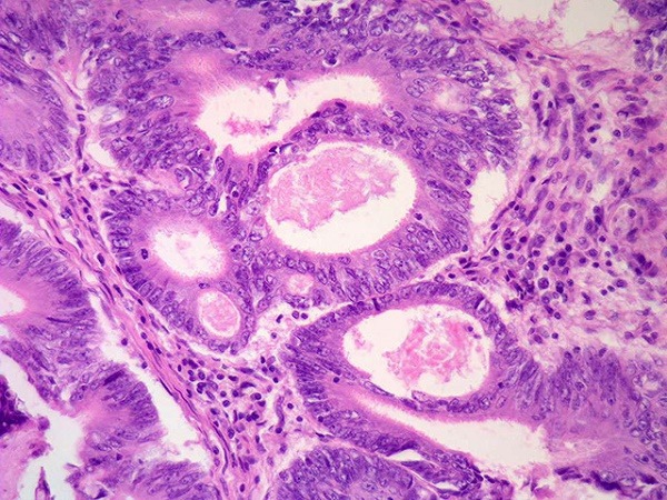 Ung thư da carcinoma tế bào gai 2