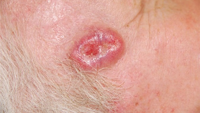 Ung thư da carcinoma tế bào gai 3